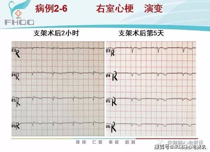 右室心肌梗死的心電圖診斷