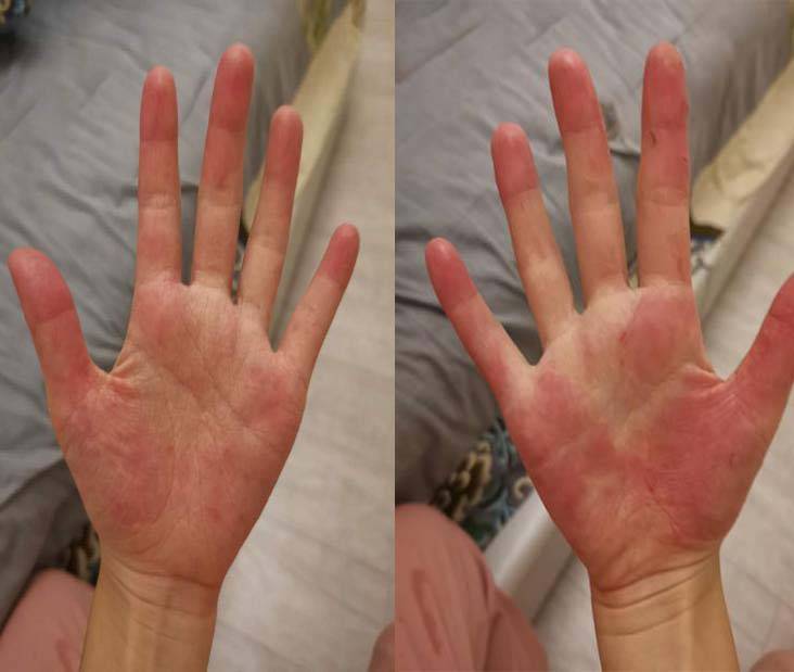 门诊案例|湿疹小女孩双手皲裂,调理脾胃后,一个月就见效_患者