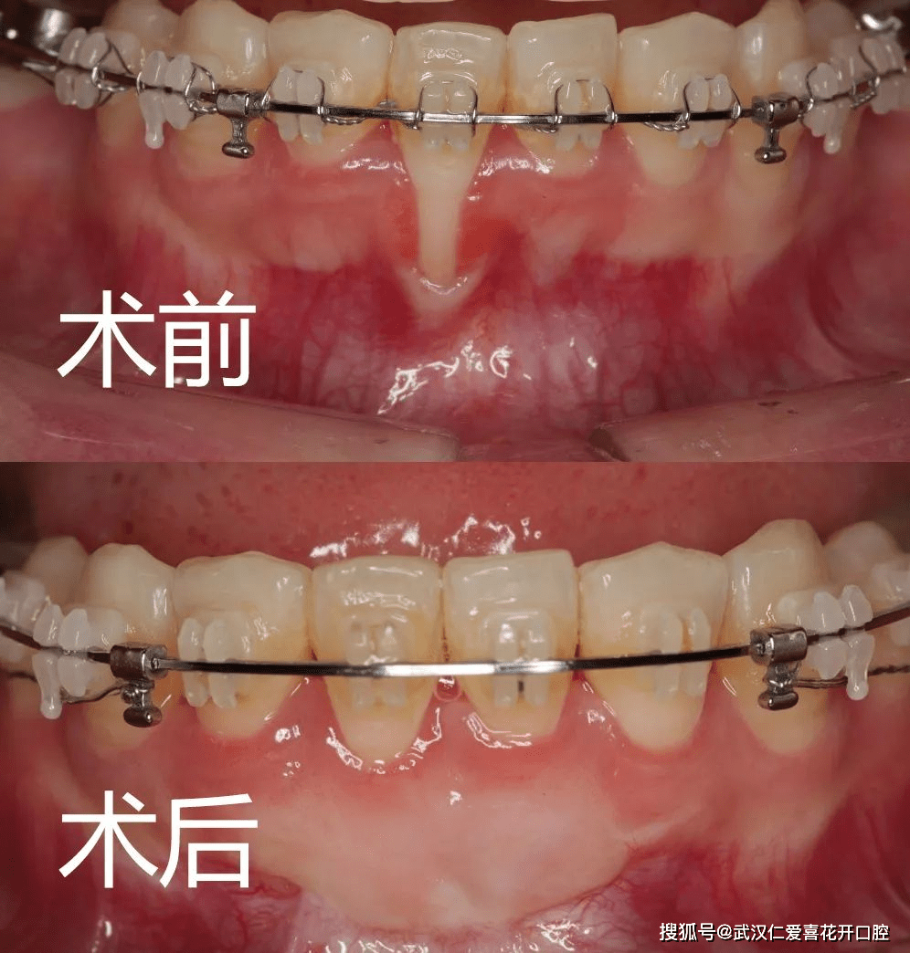 怎样才能有效的防止牙龈发炎 83ef605f4525406d8965ac8074ccc628.png