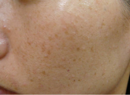 第四:日光斑如下图——皮肤表面受损而引起的色素称外伤性色斑如暗疮