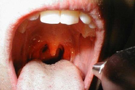 急性扁桃体炎,患者会出现高烧和明显的咽喉疼痛现象,甚至会因为咽部