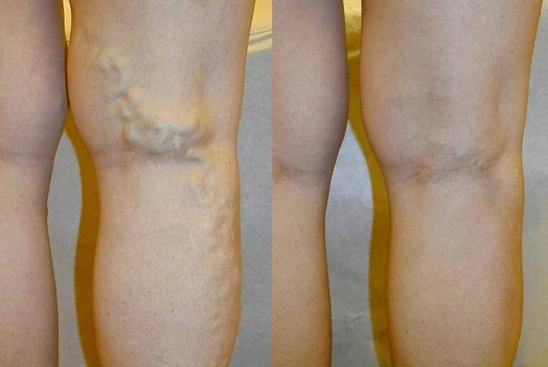 医生提醒,糖尿病患者动脉更容易动脉硬化,硬化以后血管闭塞,血液供不