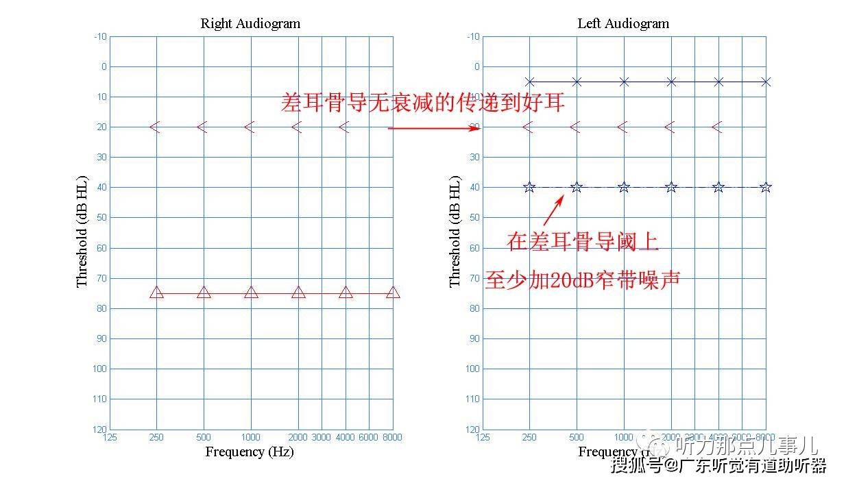 纯音测试手把手教你做骨导掩蔽