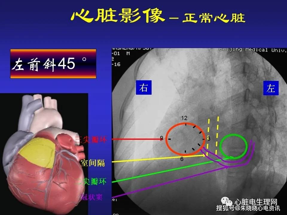 心臟電生理介入治療相關解剖影像學