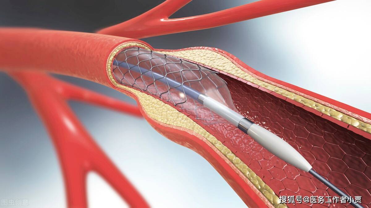 原创老年人冠心病临床治疗指南快来收藏吧