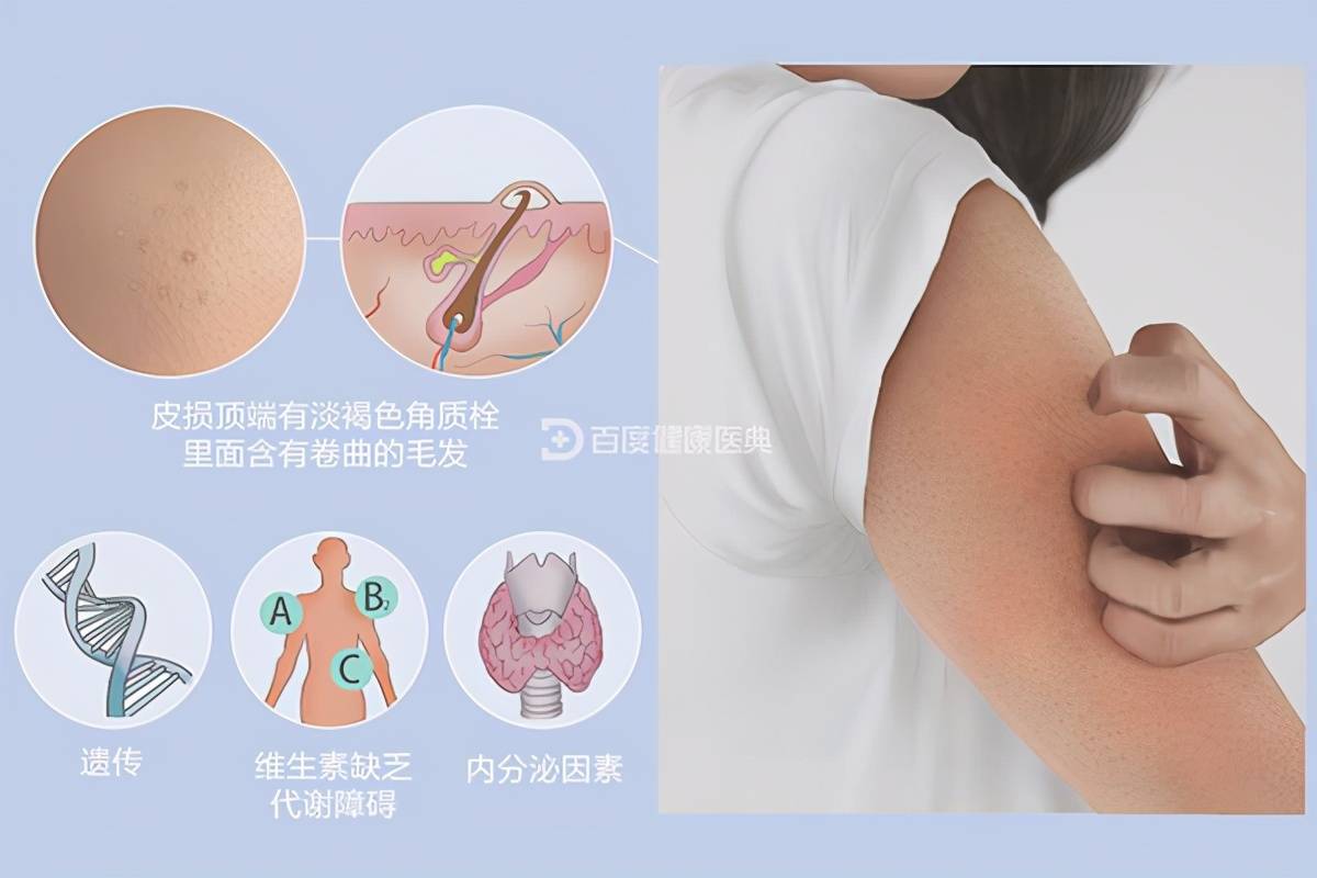 鸡皮肤中医推荐(鸡皮肤中医怎么治) 鸡皮肤中医推荐(鸡皮肤中医怎么治)