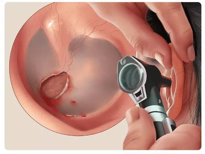 鼓膜穿孔 耳聋 不必太紧张 中耳
