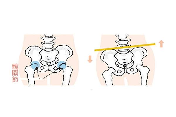所谓骨盆歪斜是因为姿势不良造成支撑骨盆的韧带,骨头和关节移位