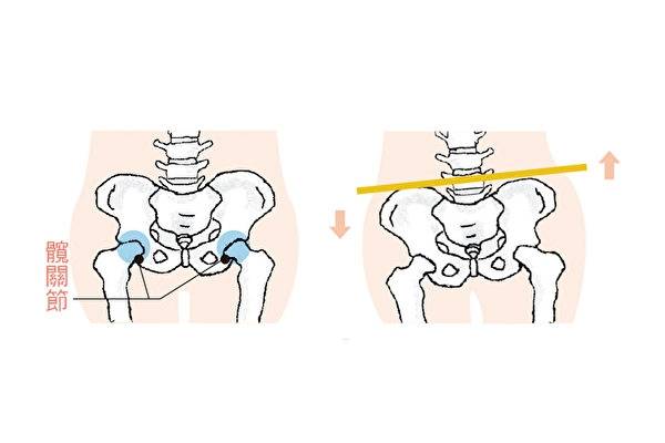 骨盆不正让你腰痛3招自我检测骨盆歪斜