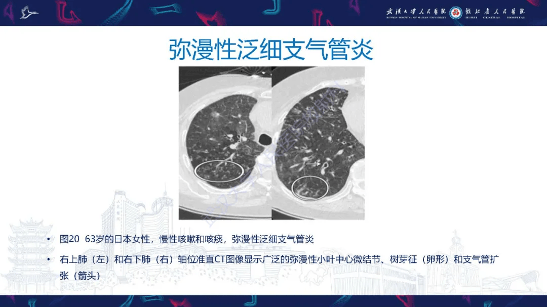 細支氣管炎影像診斷