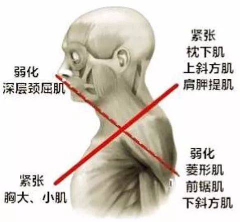 「圓肩駝背頭前引」最全矯正指南,人人都用得上