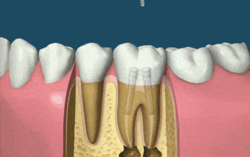 根管治疗不就是"杀神经"吗?有什么不同?_牙齿