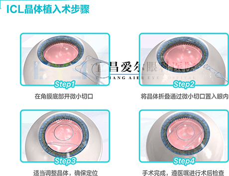 激光近视手术和晶体哪个好 24b8596531874201871e096ef4ec8372.png