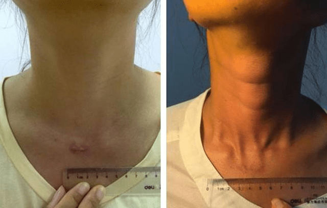 甲状腺不好的女性身体会有4个怪异现象3件事劝你少做