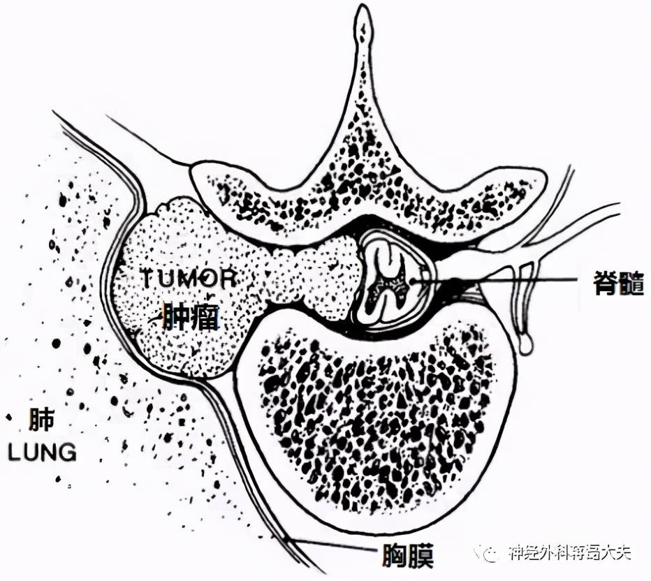 椎管啞鈴型腫瘤是怎麼回事