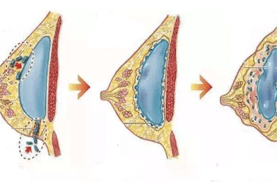 假体隆胸后包膜挛缩增生变硬怎么办?