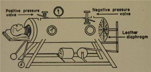 原创被困铁桶69年的铁肺人一生无法自主呼吸停电就意味着死亡