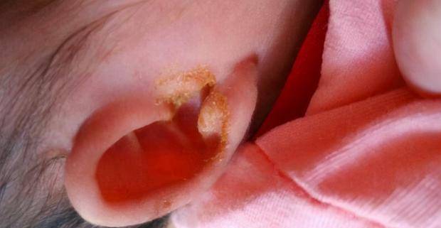 也有研究发现,随着年龄增长,有油性耳屎的人群也会慢慢转变成干性耳屎