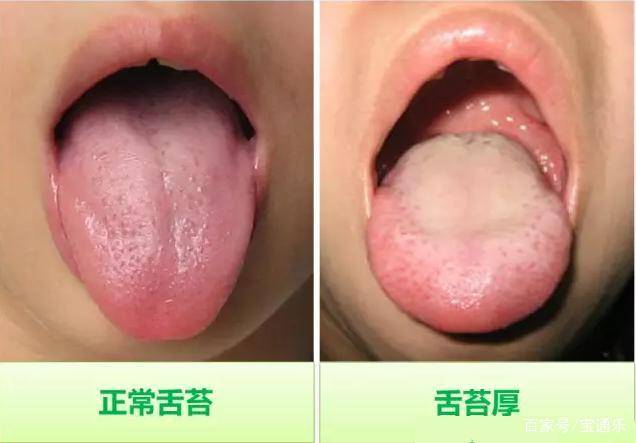 怎么看小孩子的舌苔 140b396bc9464f0a846e96d58b0c1eb3.jpeg