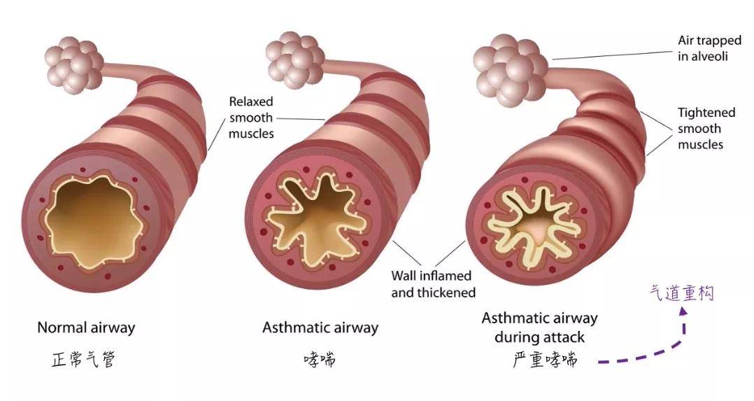气管喘气难受怎么办