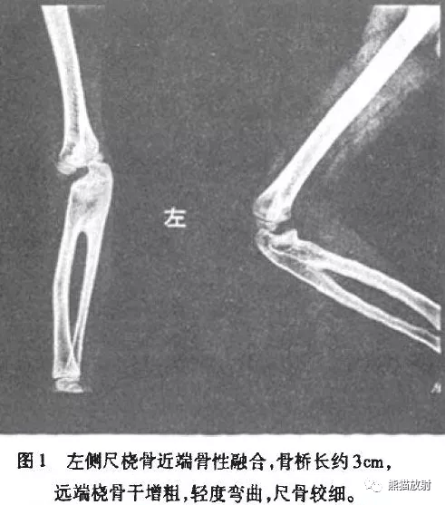 x線診斷要點丨骨與關節發育畸形(上肢)_橈骨