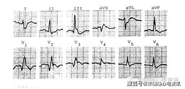 第五章心肌梗死的心电图诊断