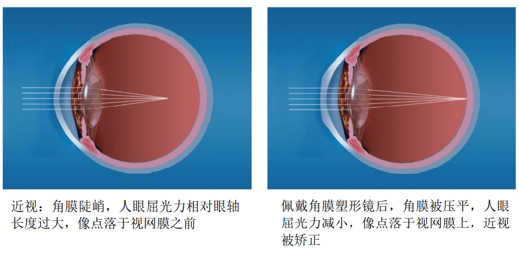 蛋白矫正沙发原理是什么_蛋白线是什么样子图片