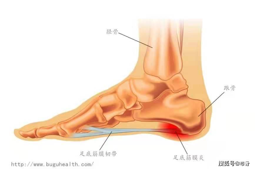 布骨医学科普足底筋膜炎是导致足跟痛的最常见原因一篇科普了解它