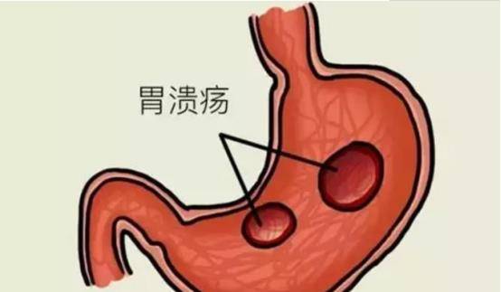 胃溃疡的常见诱因,你知道吗?