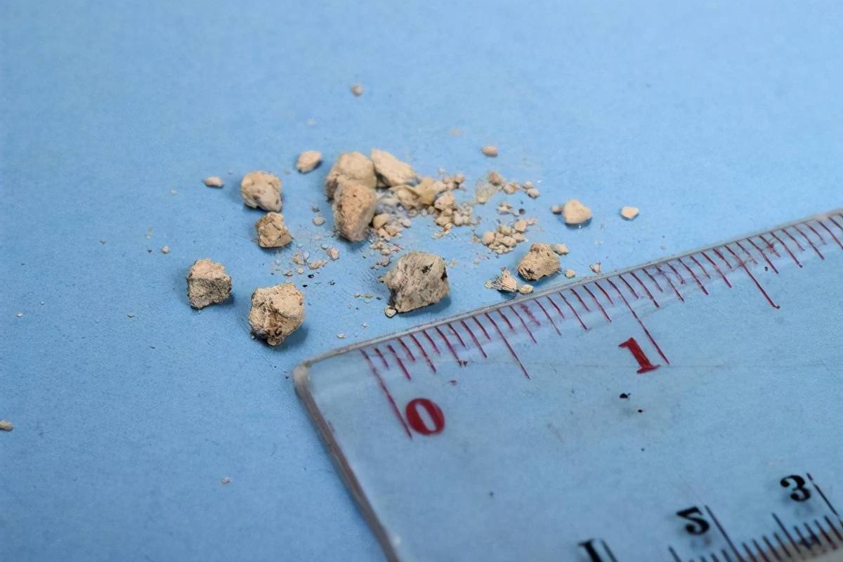 这可能会令肝细胞受到感染并受到损伤,血清内的胆红素含量因此升高