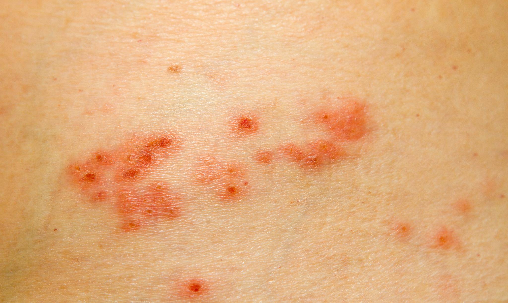 醋调六神丸治疗荨麻疹 带状疱疹白醋加雄黄治带状疱疹 自媒体热点