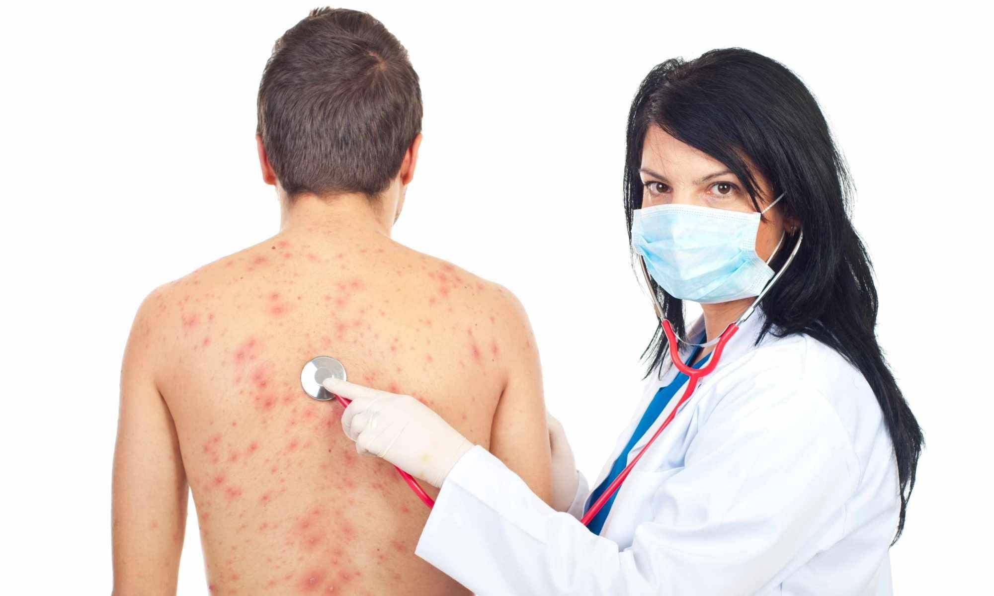 如何预防前胸后背长痘痘？