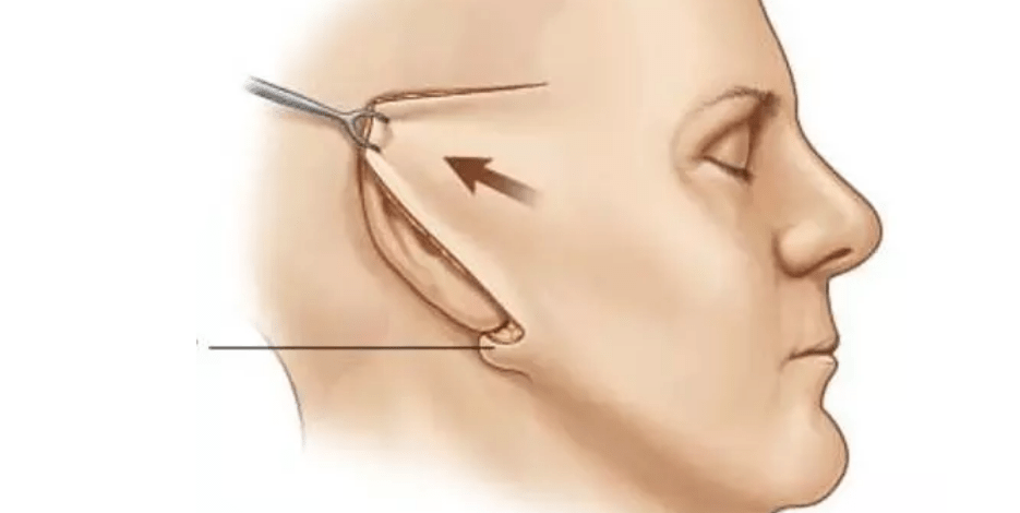 线雕和拉皮手术哪个好该怎么选择