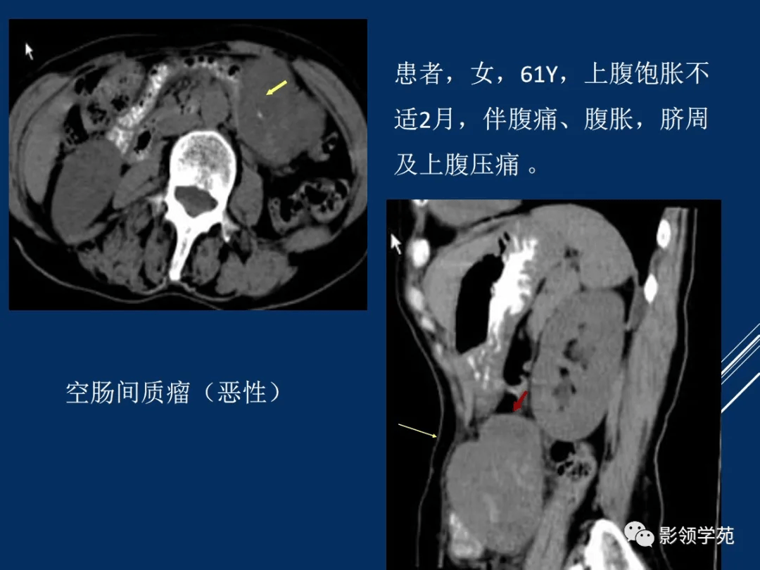 強化程度不能作為判斷惡性的指標)1,消化道壁局部增厚及軟組織塊影