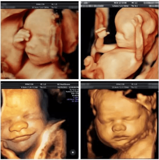 如何看懂胆囊彩超图像 2ede832b3b9640e69fb0dba1de1537b5.png