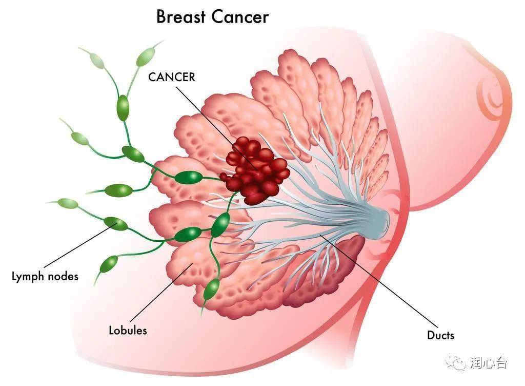 誤區八,乳腺癌就是乳房有腫塊,乳房有腫塊就是乳腺癌?