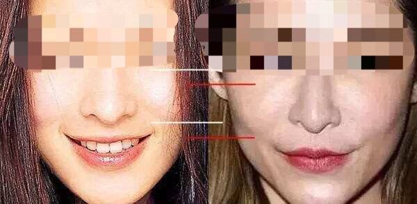 什么办法可以提升苹果肌 ef524d3922684770880537645caab29a.jpeg