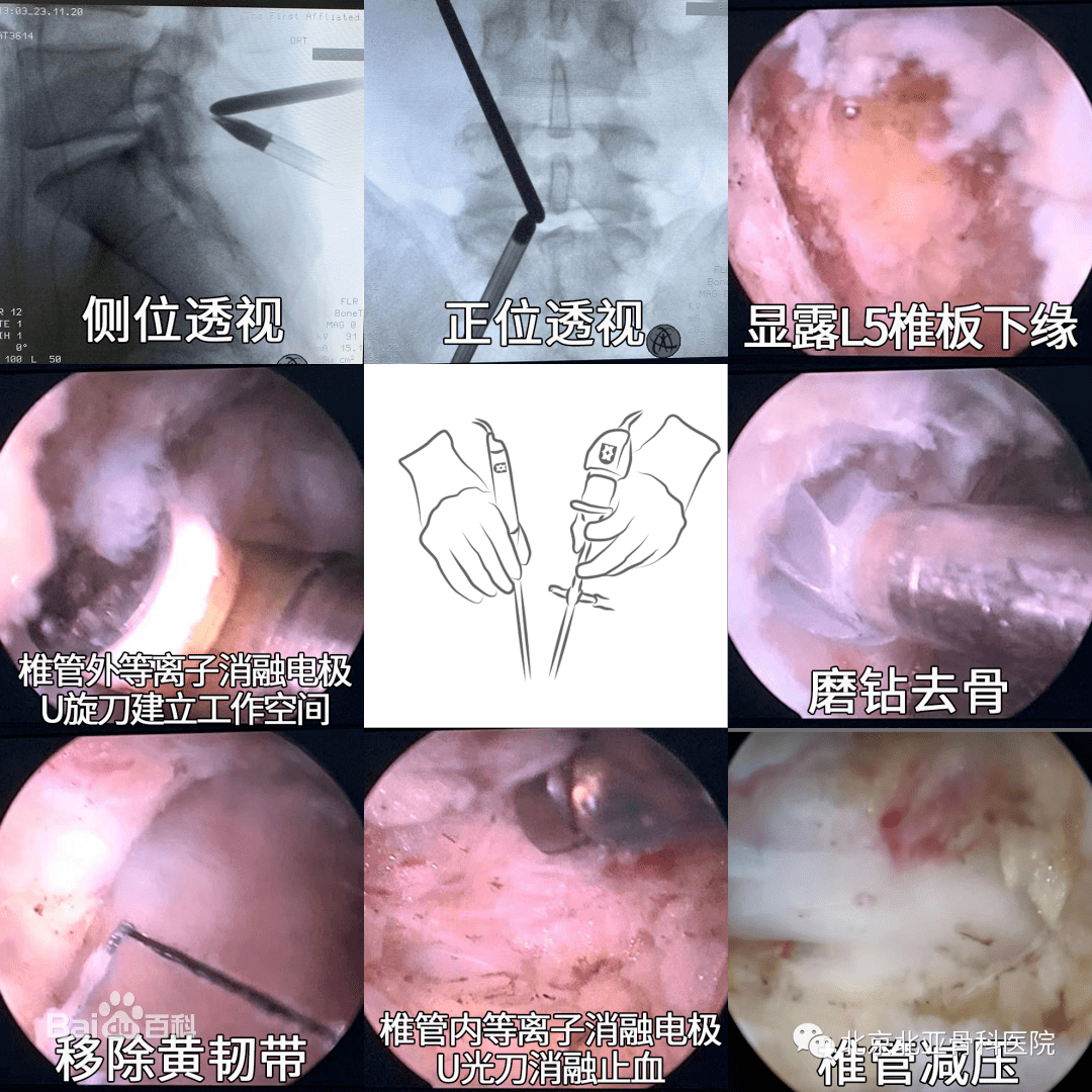 ube技术解决腰椎间盘突出症