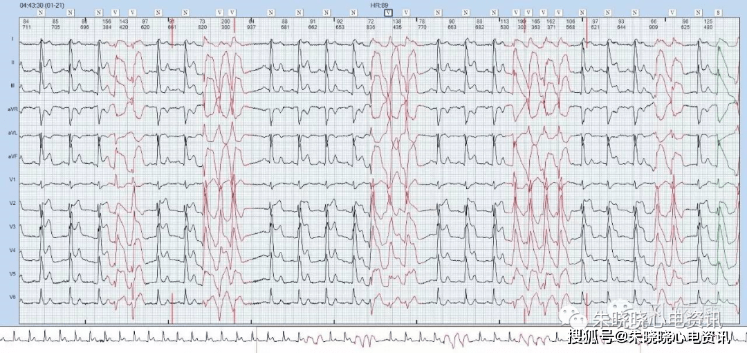 心肌梗死从红旗飘飘到墓碑留名全过程