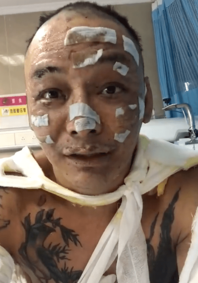 歌手徐真真自曝因点香薰蜡烛引发火灾 全身二级深度烧伤