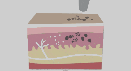 洗纹身真的可以洗干净,不留疤?_激光