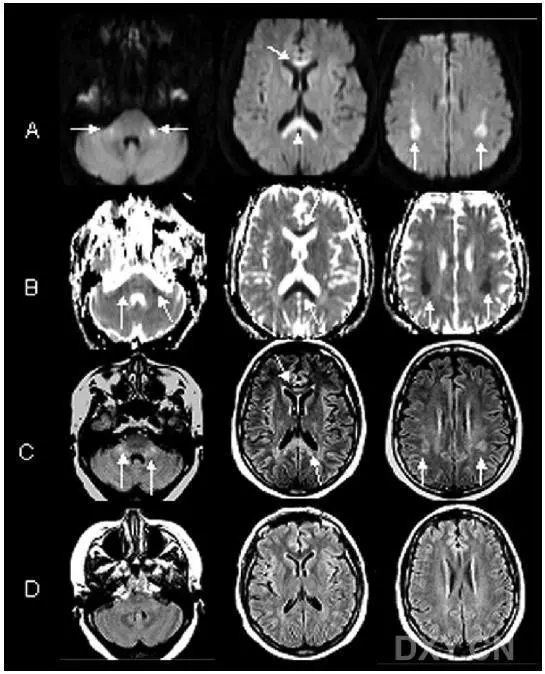 藥物或毒物相關性腦白質病變_信號