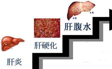 癌症肝癌十大信号_癌症肝癌早期能治愈吗_肝癌症前期的18种预兆