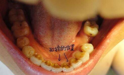 牙齿内侧黄黄的脏东西好恶心怎么抠怎么刷都没用教你一招