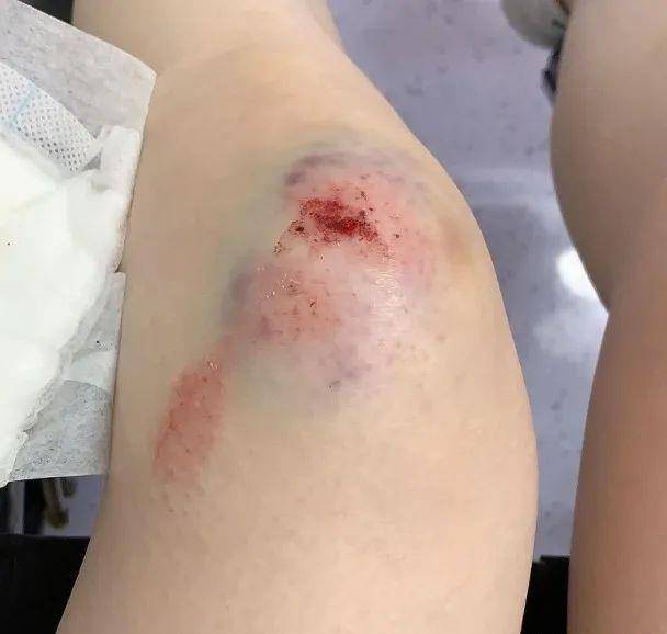 原创意外!爱犬突然失控导致主人摔落楼梯,时隔一月女星被查出骨裂