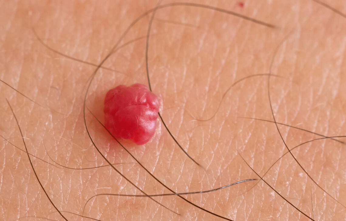 皮肤乳头状瘤生长方式图片