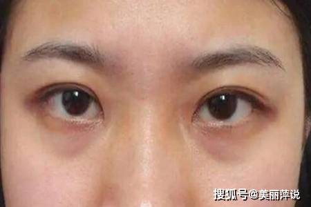 黑眼圈重怎么快速消除 这四个去黑圈最有效的方法 按摩