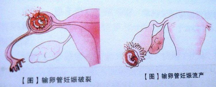 为什么越来越多女性患"宫外孕"?这3大原因,男人都脱不了干系