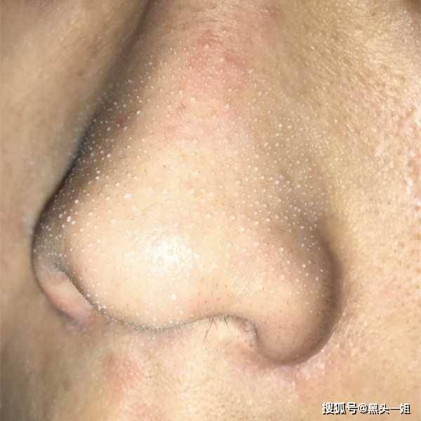 粉刺夹黑头 d8fd853ac255464e850aa0c2960ff553.jpeg