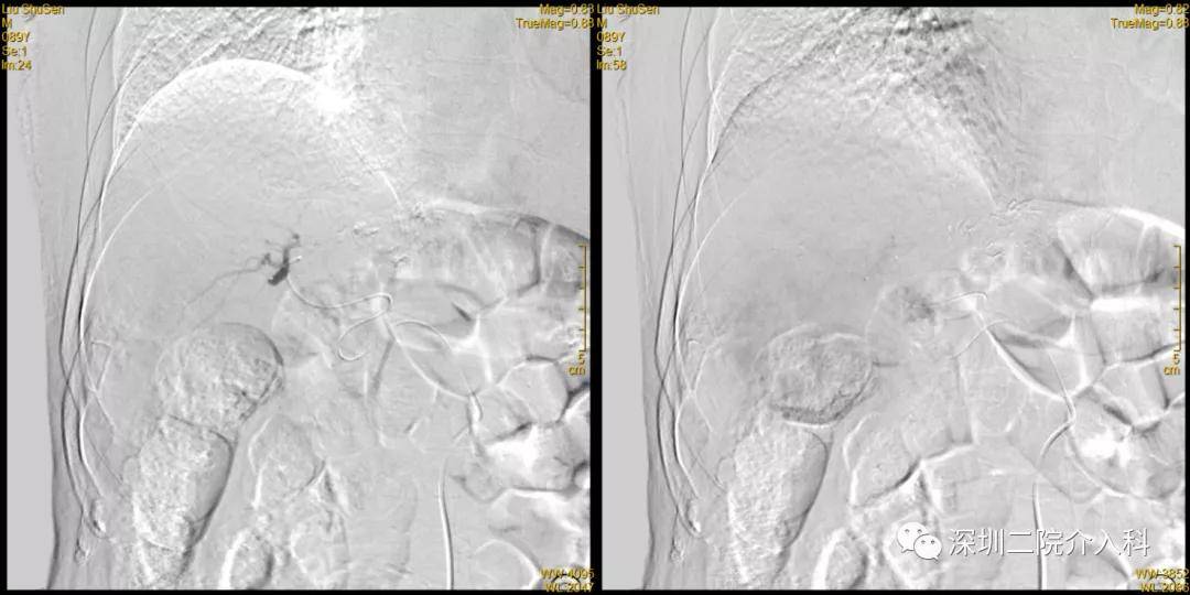 患者|高龄患者得肝癌就要放弃治疗？介入医生说“NO”！